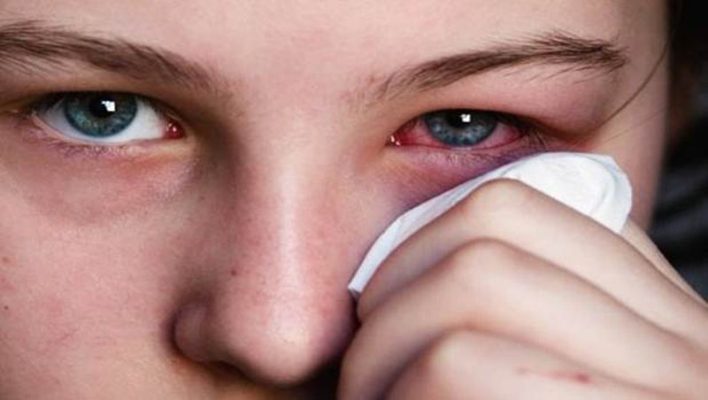 Gripi i syrit, në qarkullim/ Okulistët: Janë shtuar rastet e sëmundjes tek fëmijët dhe të rinjtë