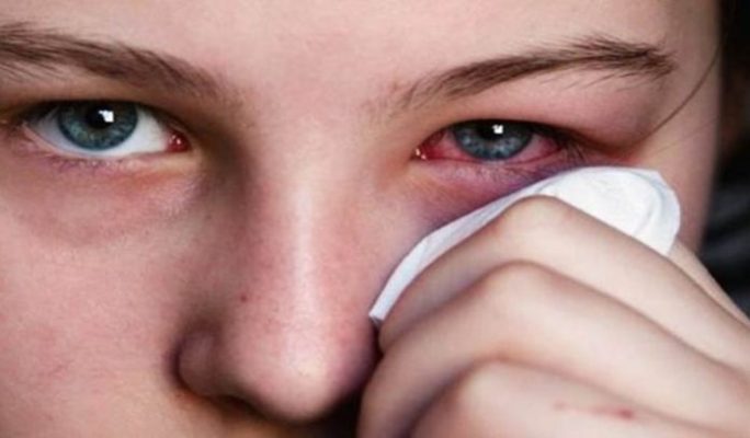 Mjekët: Kujdes me gripin e syrit, mund të shkaktojë komplikacione të rënda