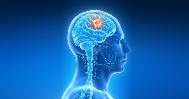 Nga dëgjimi i tingujve tek harresa, simptomat e pazakonta të një tumori në tru