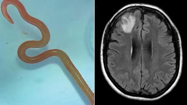Gjendet krimb i gjallë 8cm në trurin e një gruaje/ Mjekët: Kurrë më parë një rast i tillë tek njerëzit, vetëm tek gjarpërinjtë