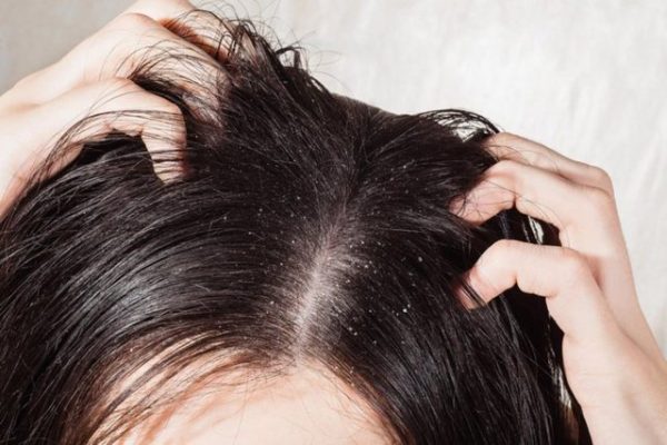 6 arsye pse flokët yndyrosen shumë shpejt dhe çfarë duhet të bëni
