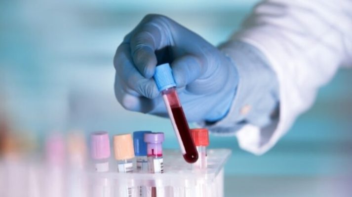 Shkencëtarët zbulojnë testin e gjakut që mund të diagnostikojë disa lloje të kancerit të trurit