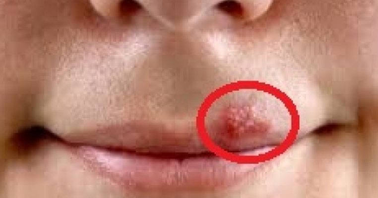 3 metoda që zhdukin herpesin në buzë brenda ditës