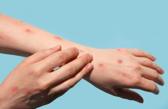 3 simptomat paralajmëruese të alergjisë që duhet të njihni të gjithë