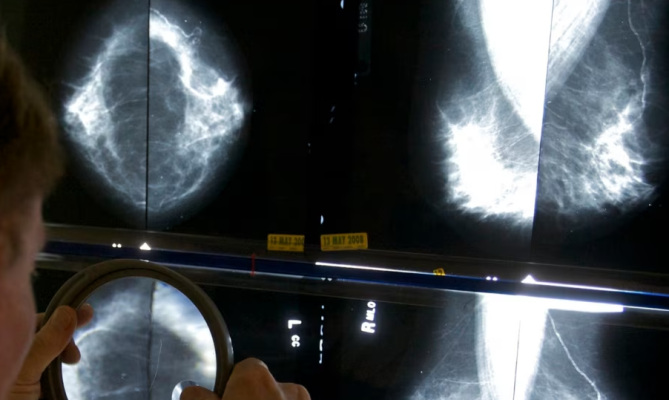 Ekspertët: Mamografia të fillojë në moshën 40 vjeçare